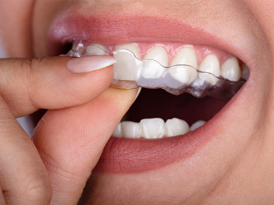 Park Street Dental Associates | Implant Dentistry, Emergency Treatment and Veneers