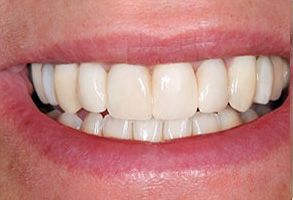 Park Street Dental Associates | Implant Dentistry, Cosmetic Dentistry and Oral Cancer Screening