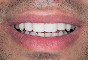 Park Street Dental Associates | Root Canals, Dental Fillings and Cosmetic Dentistry