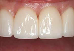 Park Street Dental Associates | Sedation Dentistry, Digital Impressions and TMJ Disorders