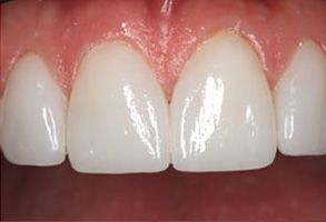 Park Street Dental Associates | Digital Impressions, TMJ Disorders and Implant Dentistry