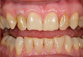Park Street Dental Associates | Ceramic Crowns, Digital Radiography and Dental Fillings