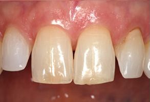 Park Street Dental Associates | Invisalign reg , Dentures and Veneers